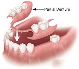 partial-dentures-st-louis