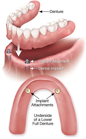 implant-overdenture