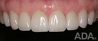 porcelain-veneers-after