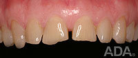 porcelain-veneers-before