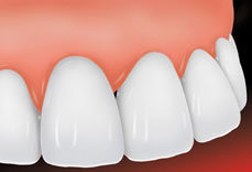 porcelain-veneers-st-louis-2