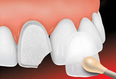 porcelain-veneers-st-louis