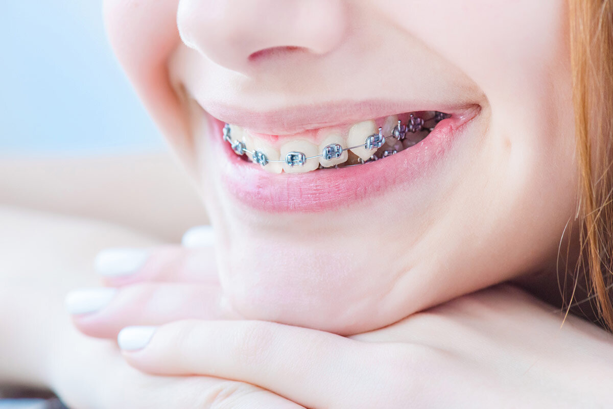 When is the Right Time to Have Your Child Evaluated for Braces? 