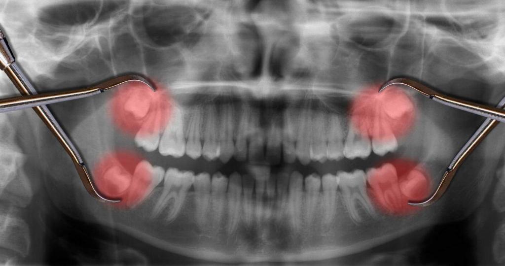 wisdom teeth x-ray