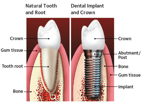 dental implants st louis