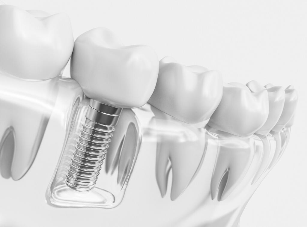 How Long Do Dental Implants Last