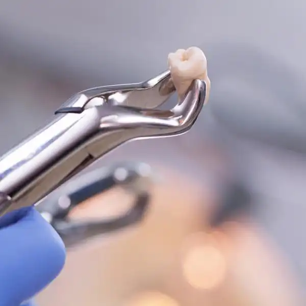 Wisdom Teeth Removal St. Louis