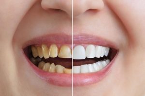 Cosmetic Dentist St. Louis