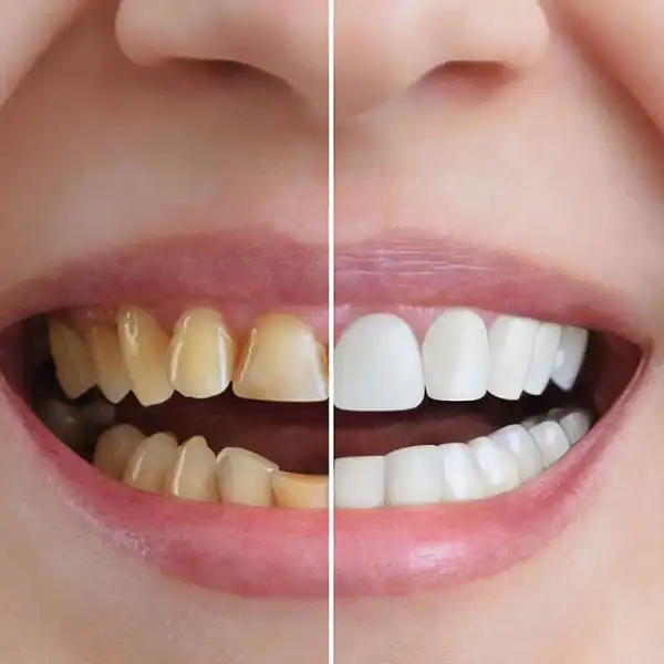 Cosmetic Dentist St. Louis