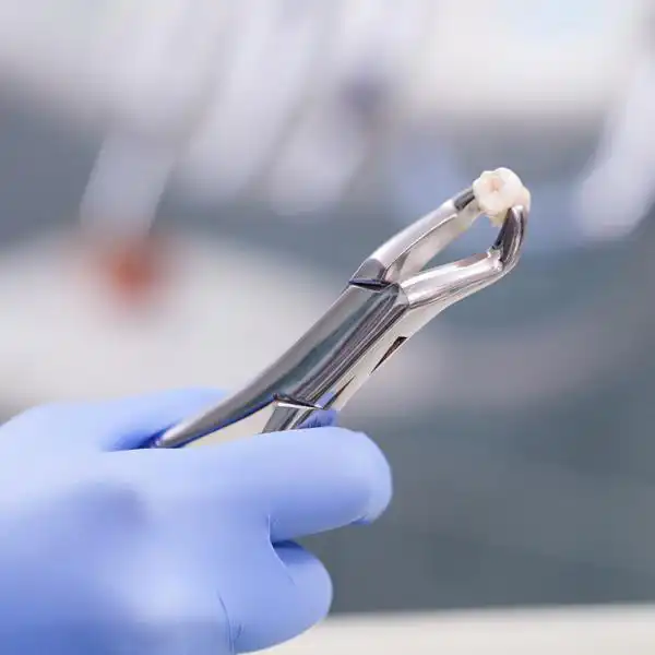 Sedation for Tooth Extraction
