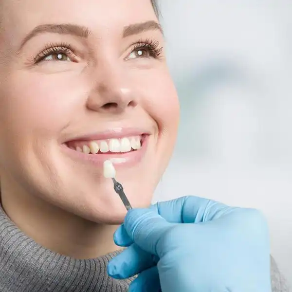 Facts About Veneers