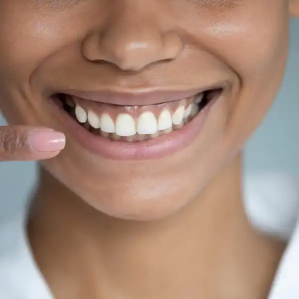 How Long Do Veneers Last