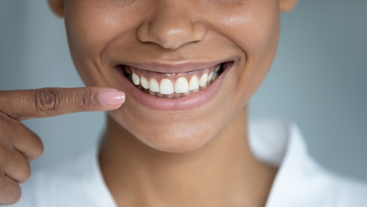 How Long Do Veneers Last