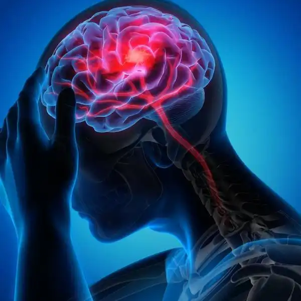 Link Between Gum Disease and Stroke