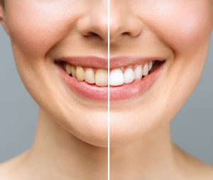 Facts about Teeth Whitening