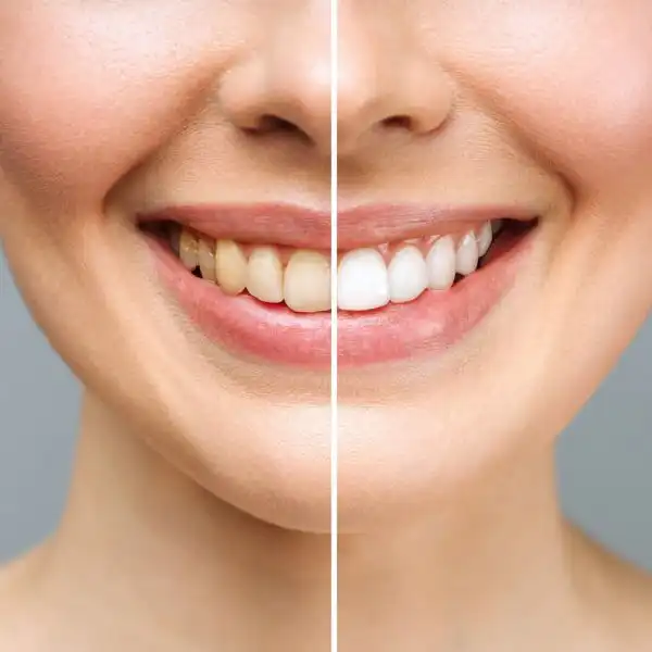 Facts about Teeth Whitening