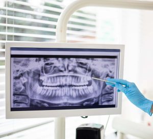Are Dental X-Rays Safe
