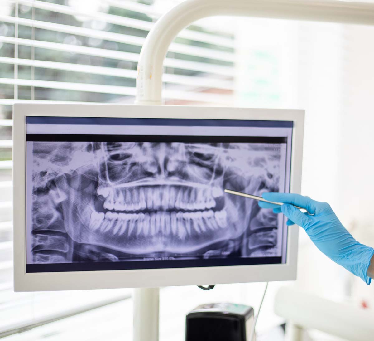 The Safety of Dental XRays What You Need to Know
