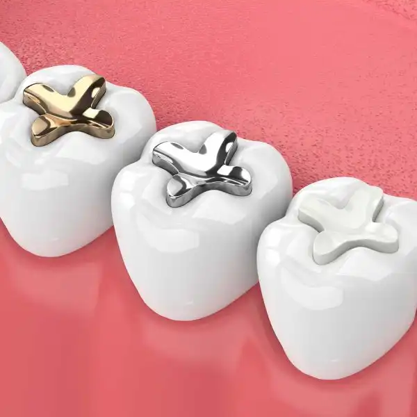 Dental Filling for a Cavity