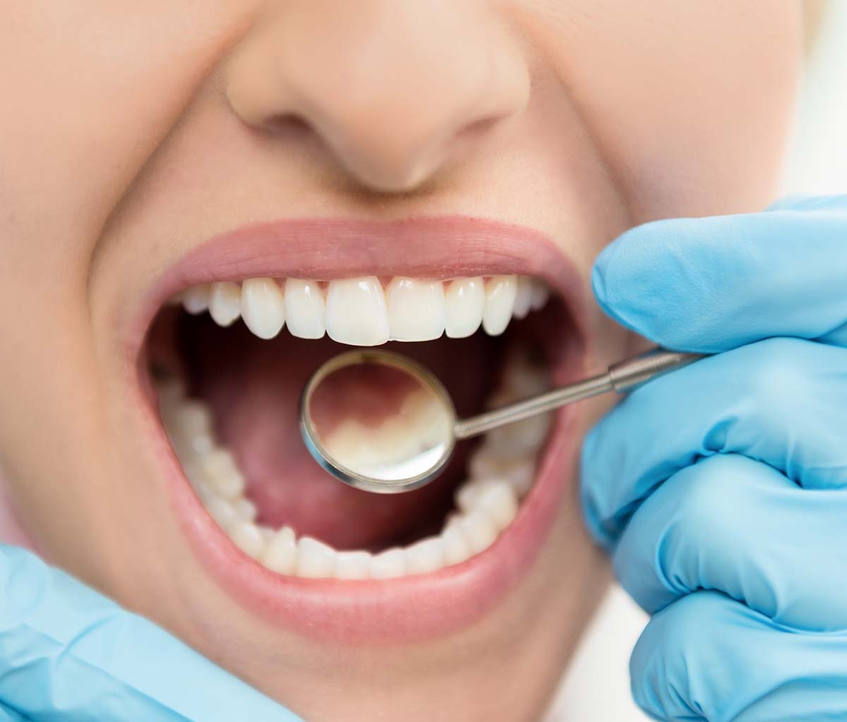 Dental Filling Process